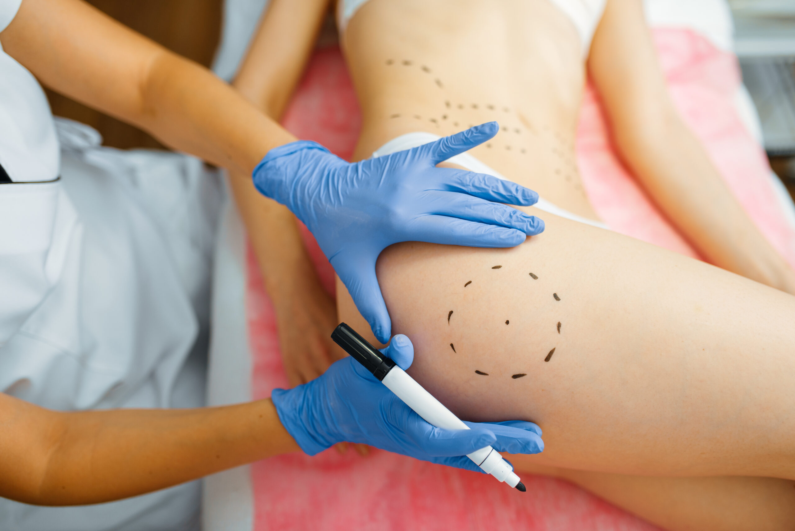 Liposuction (Liposakşın)