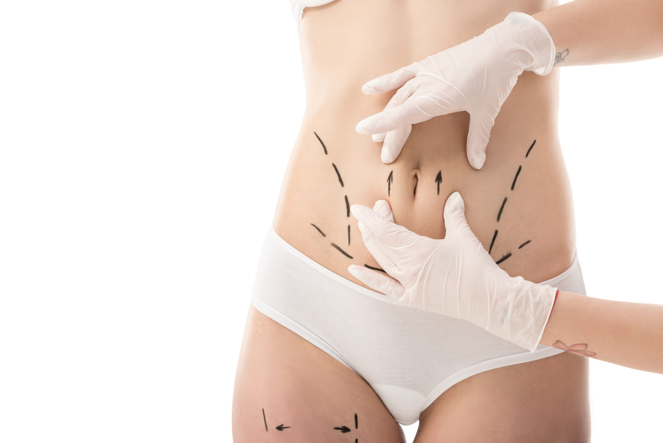 Liposuction (Liposakşın)