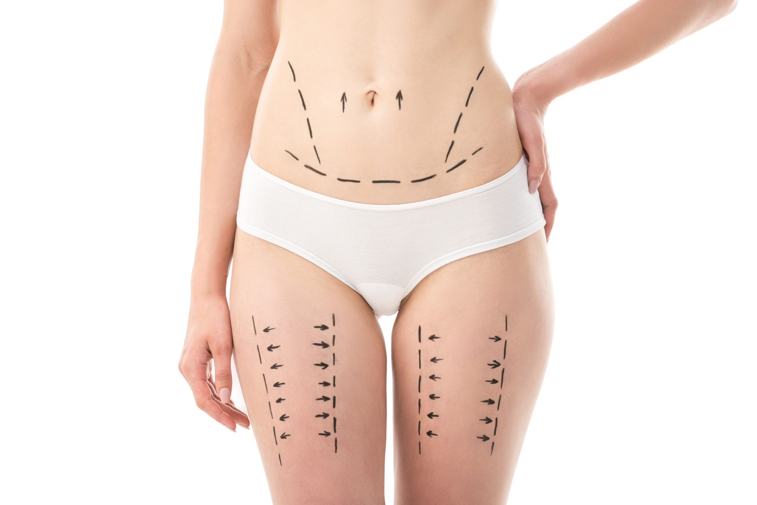 Liposuction (Liposakşın)