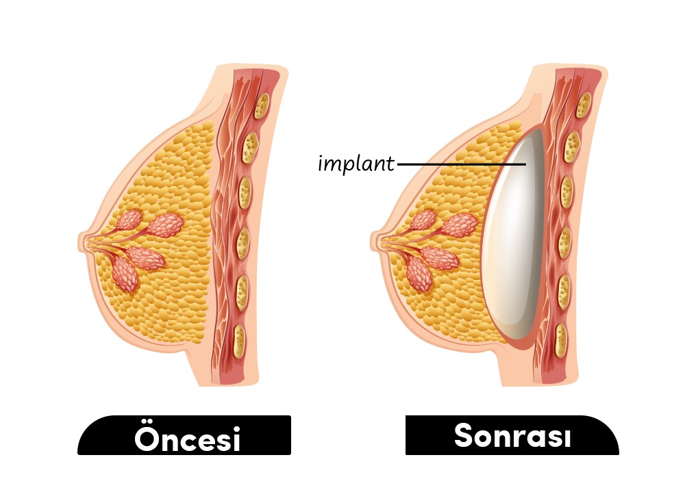 Meme Büyütme Öncesi Sonrası