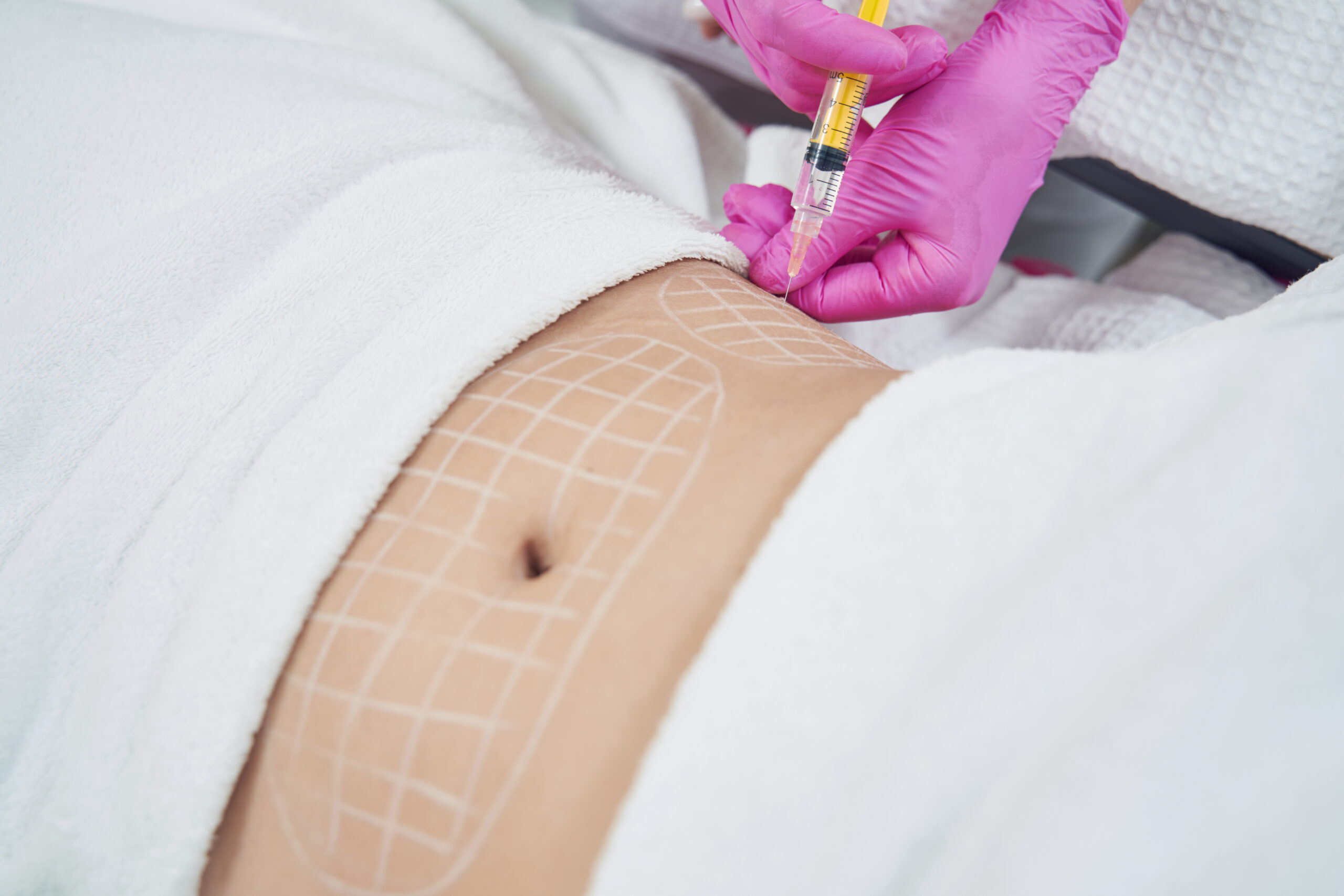 Liposuction (Liposakşın)